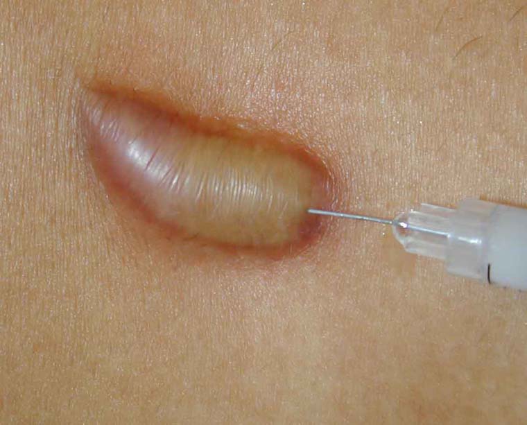 Intralesional steroid injection for keloid removal