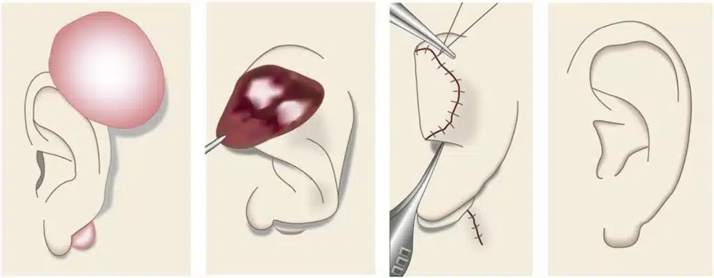 ear keloid fillet flap steps