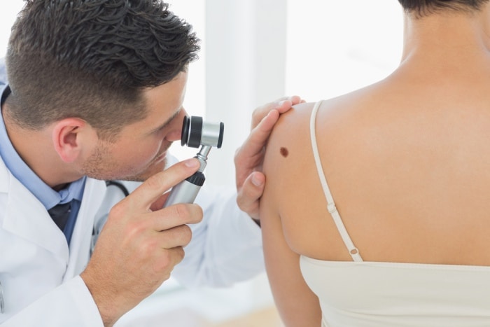 doctor examining a mole using a dermatoscope