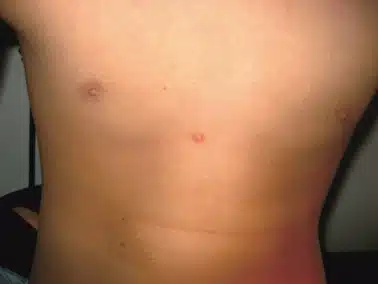 Erythematous keloid on the mid-chest after mole removal