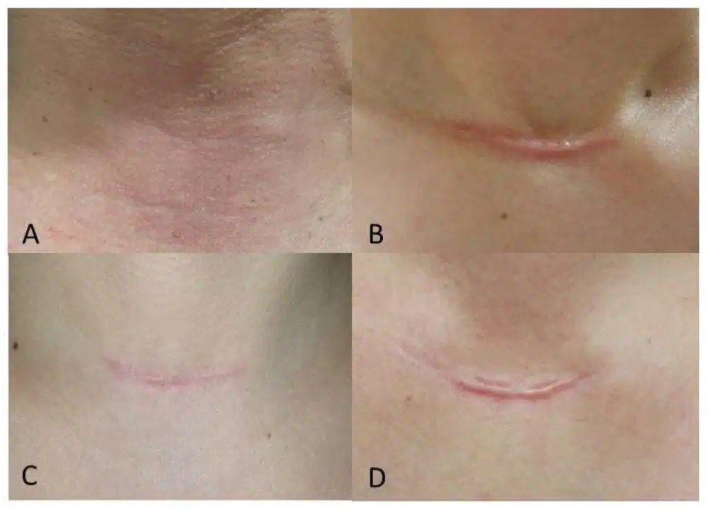 Effect of Botulinum Toxin A on Scar Healing after Thyroidectomy: A Prospective Double-blind Randomized Controlled Trial