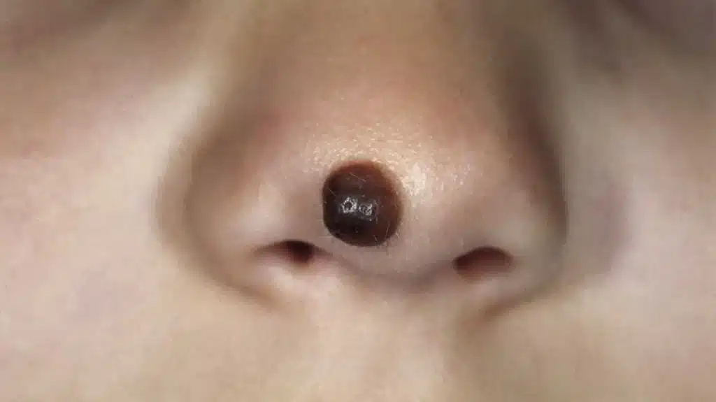 child with mole on nose tip