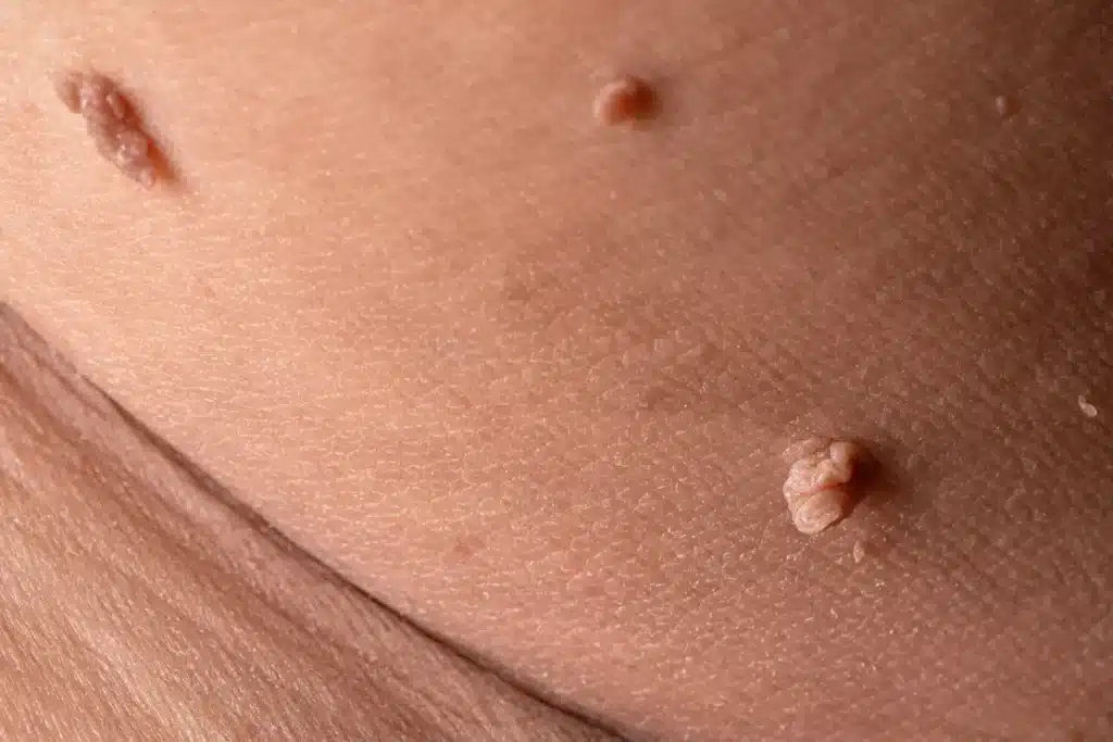 multiple skin tags on the neck prior to skin tag removal