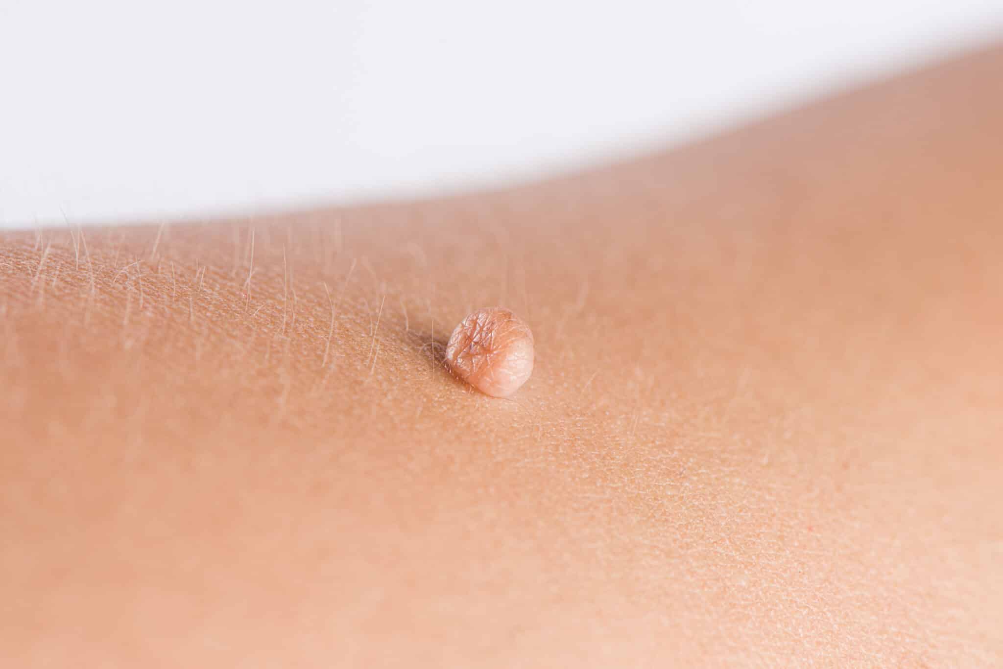 Can hormonal changes cause skin tags to develop?
