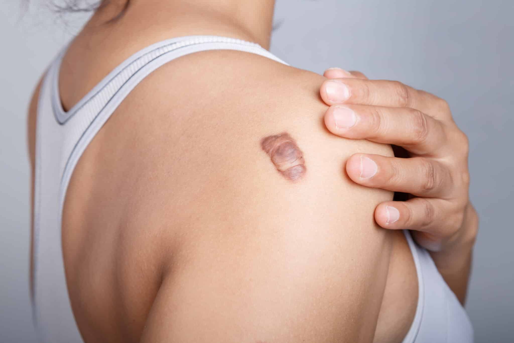 Scar on the back of the Shoulder