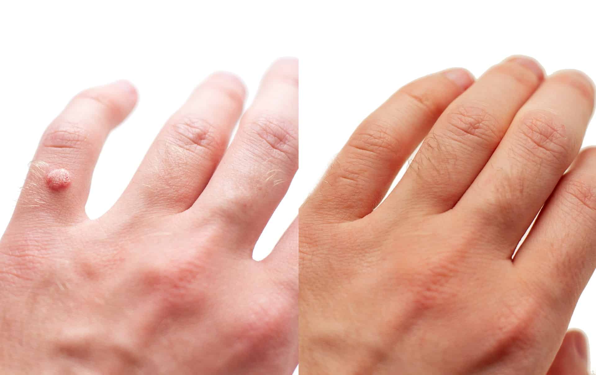 Wart removal before and after