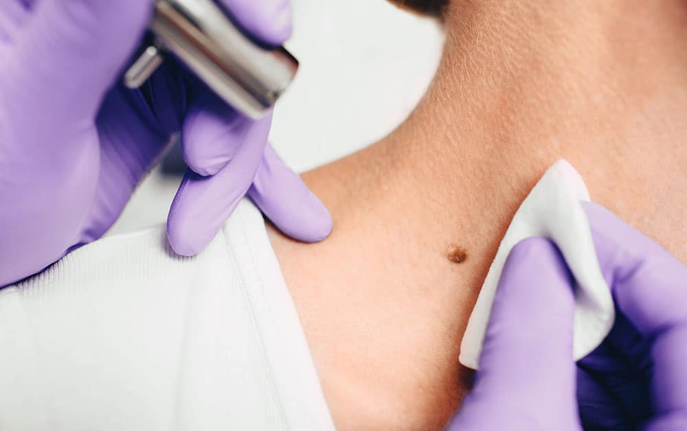 Laser mole removal in Singapore