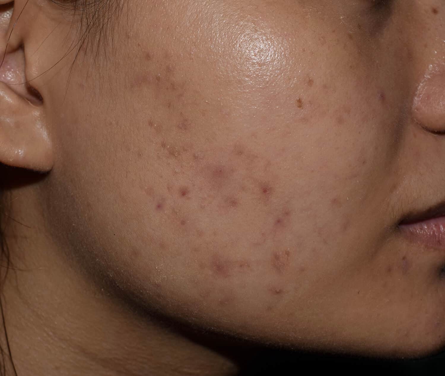 Close-up of an Asian woman’s cheek showing acne scars and dark spots.