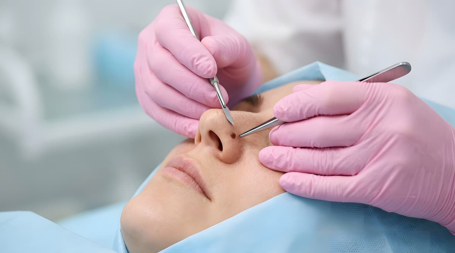 Patient undergoing mole removal